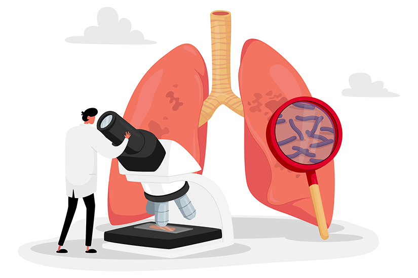 Ilustrație tuberculoză